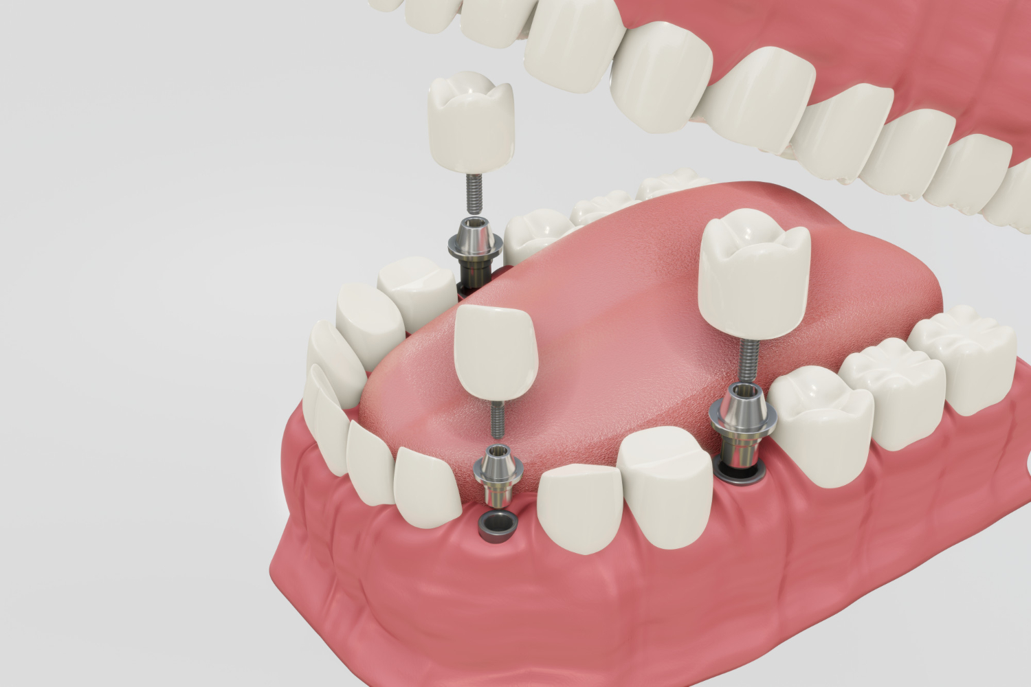 implantes dentales procedimientos